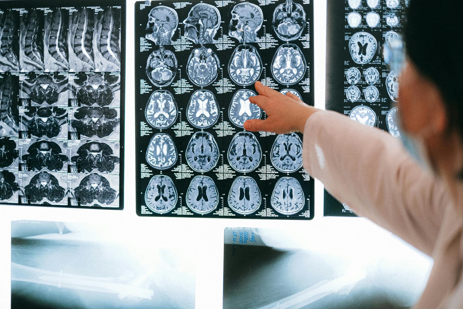 Donanemabe: conheça os prós e contras do novo medicamento para tratar casos de Alzheimer