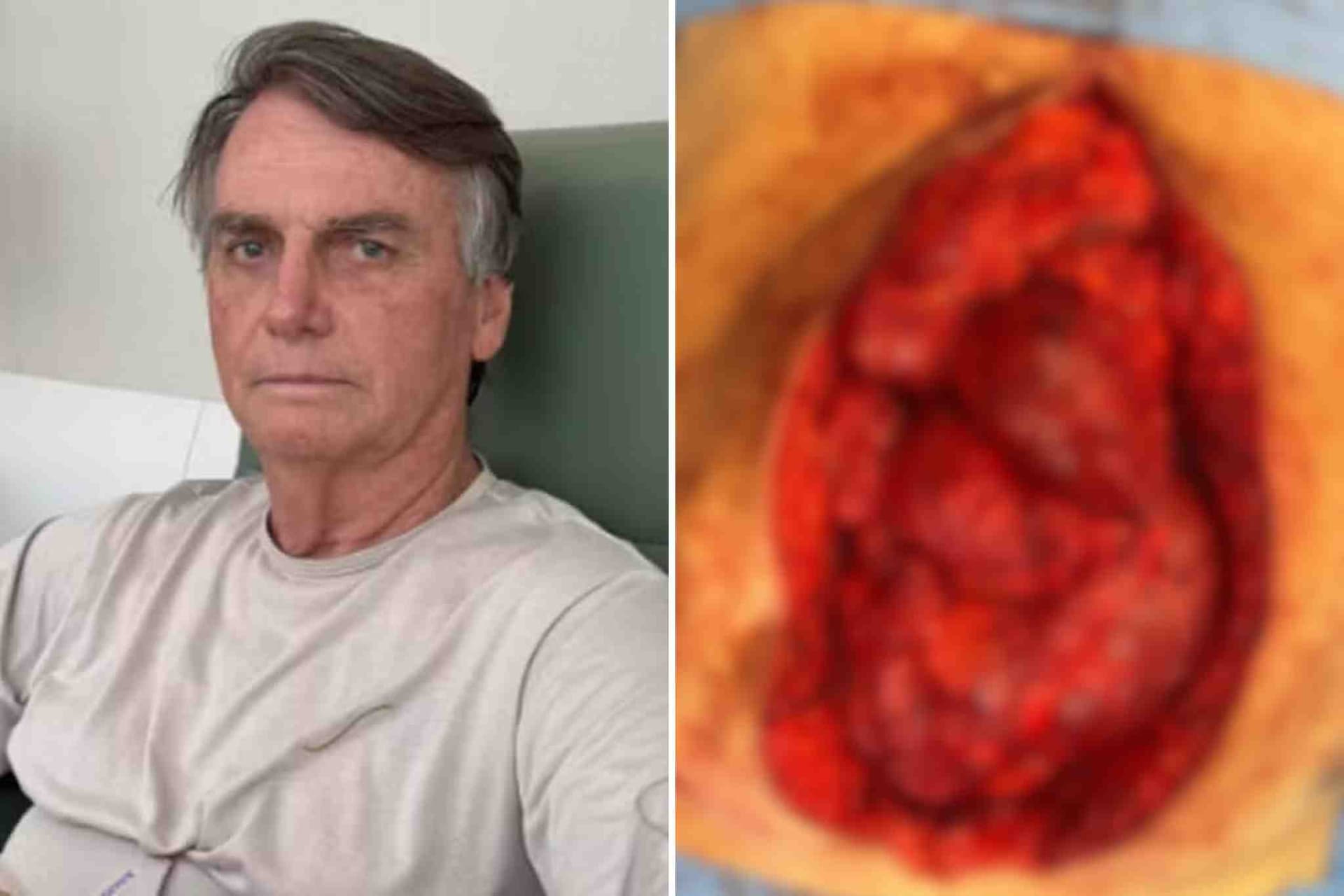 Bolsonaro publica foto do intestino exposto e choca redes sociais
